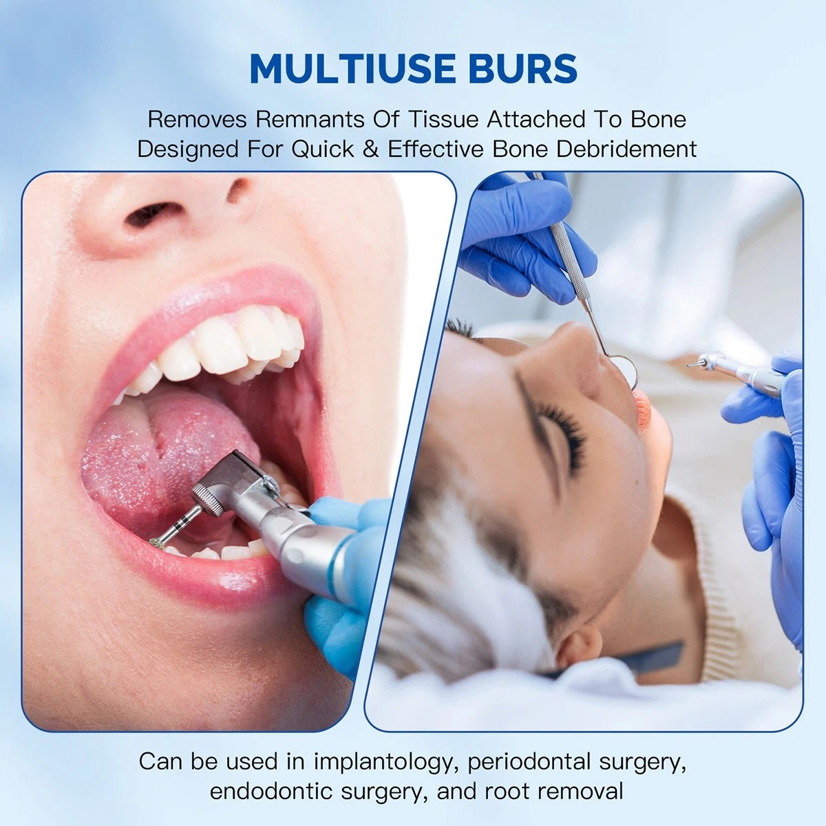 Gold Cura Dental Degranulation Kit – Surgical Debridement Burs